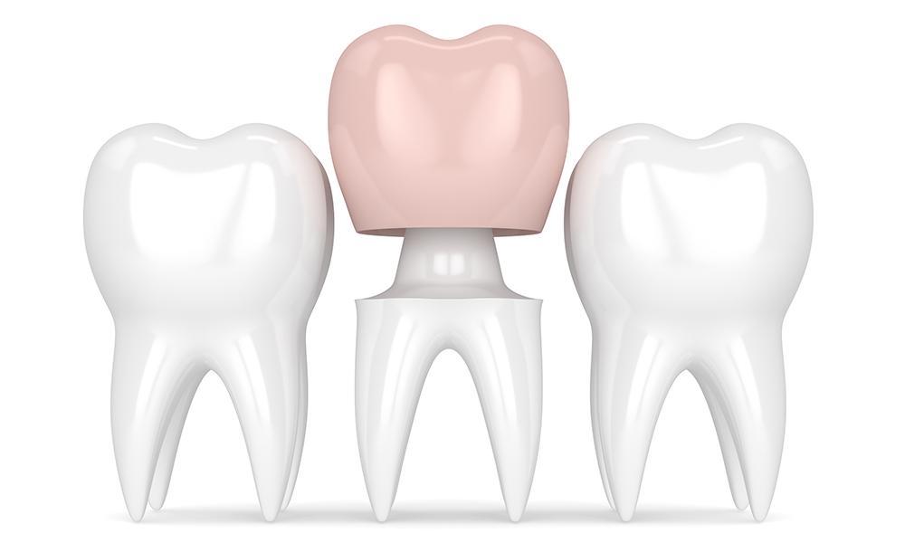 People's Teeth Decay Under Gold Dental Crowns