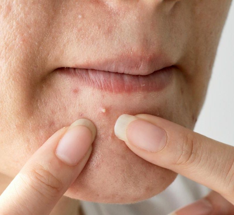 What are the causes of acne?