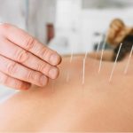 Acupuncture for Stress