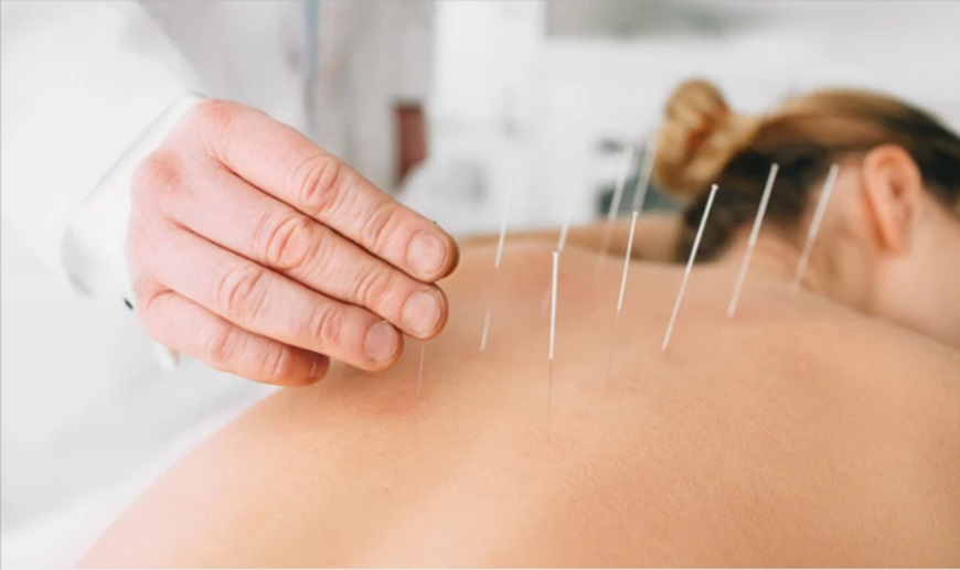 Acupuncture for Stress