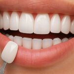 The Advantages of Porcelain Veneers for Your Dental Concerns